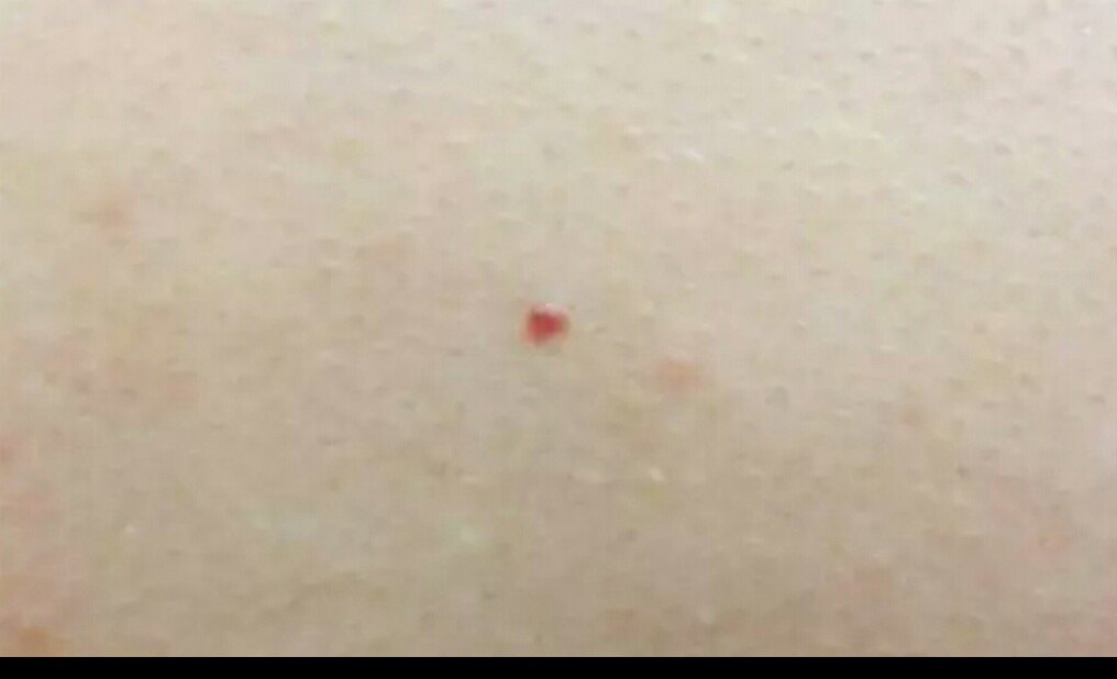 皮肤上的小红点是什么 会癌变吗 身上皮肤出现红点 丹若网