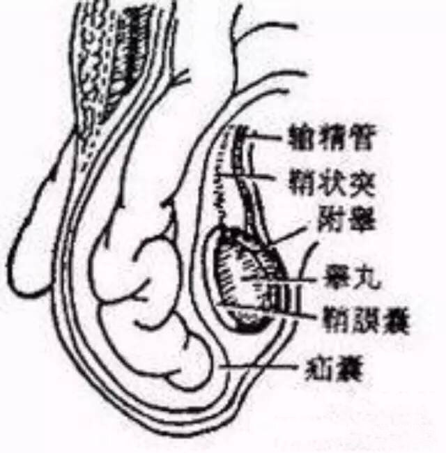 残留了一个缺口,导致肠子,卵巢或大网膜沿着缺口跑到腹股沟区或阴囊里