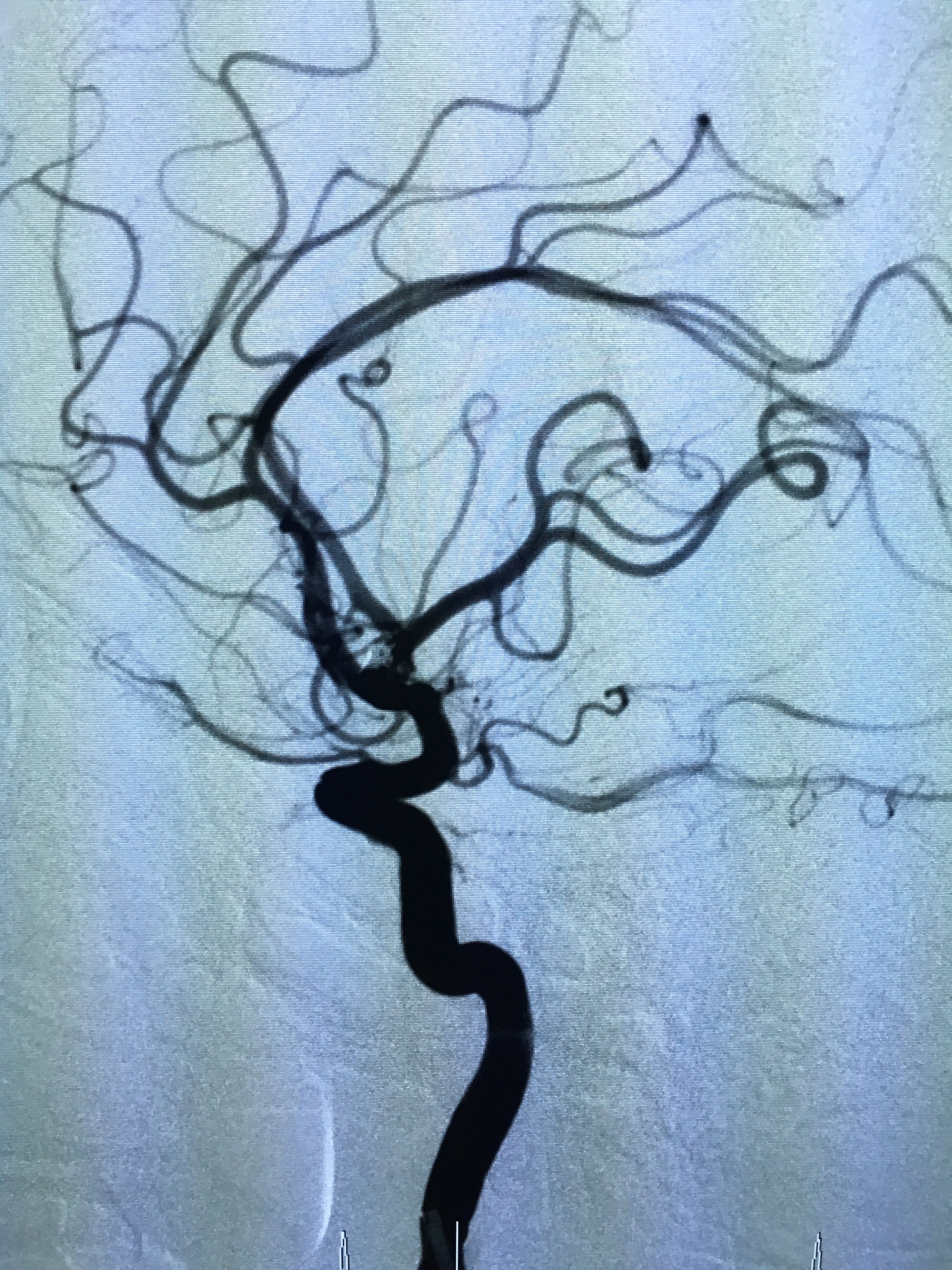 磁共振血管造影 脑部图片