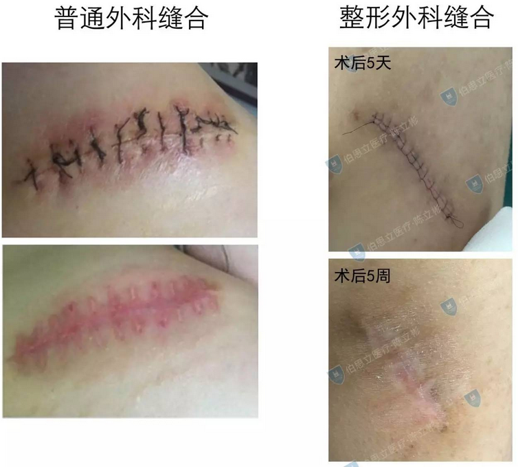 图说"减张精细缝合" - 好大夫在线