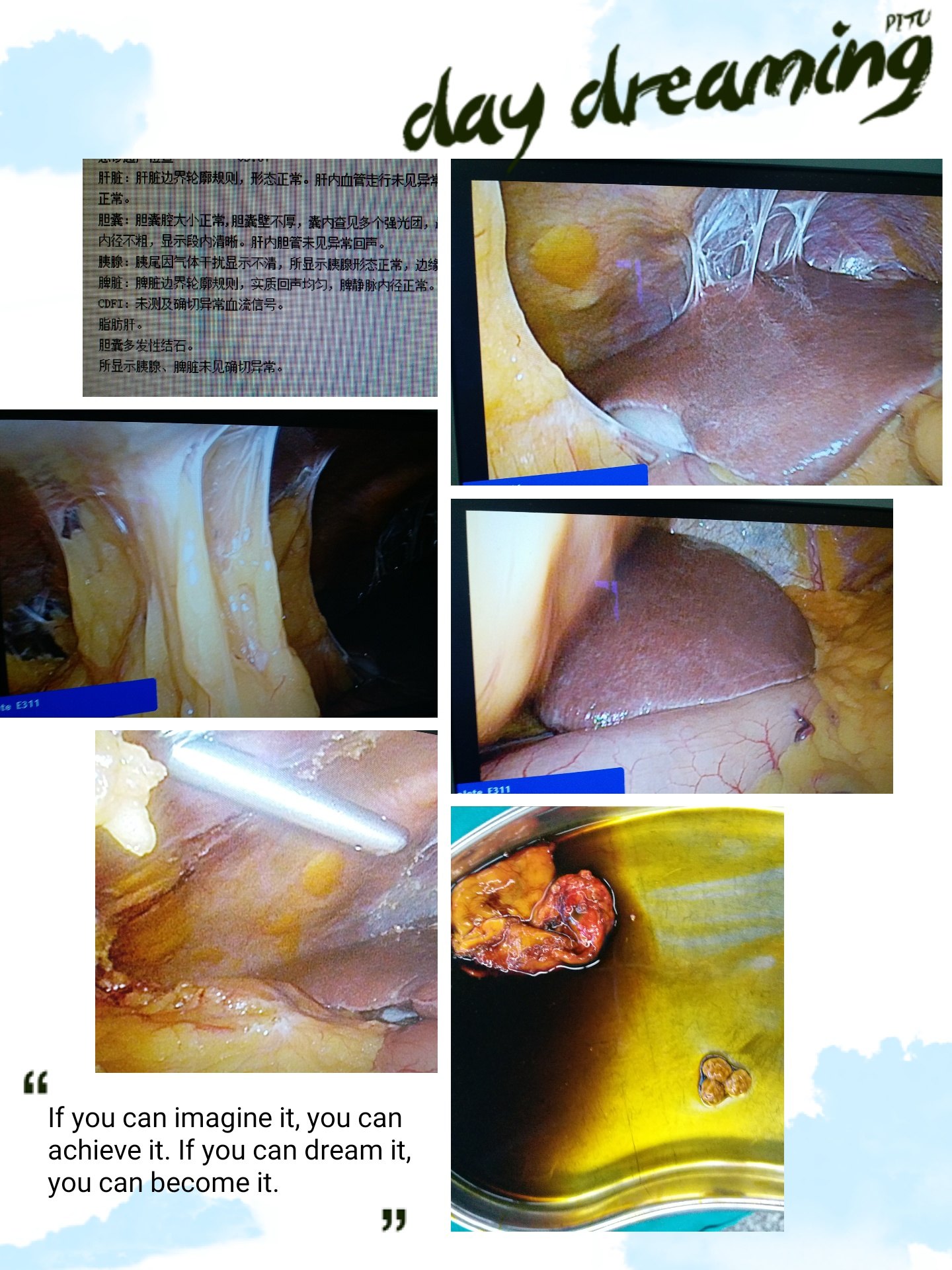 腹腔鏡膽囊切除術