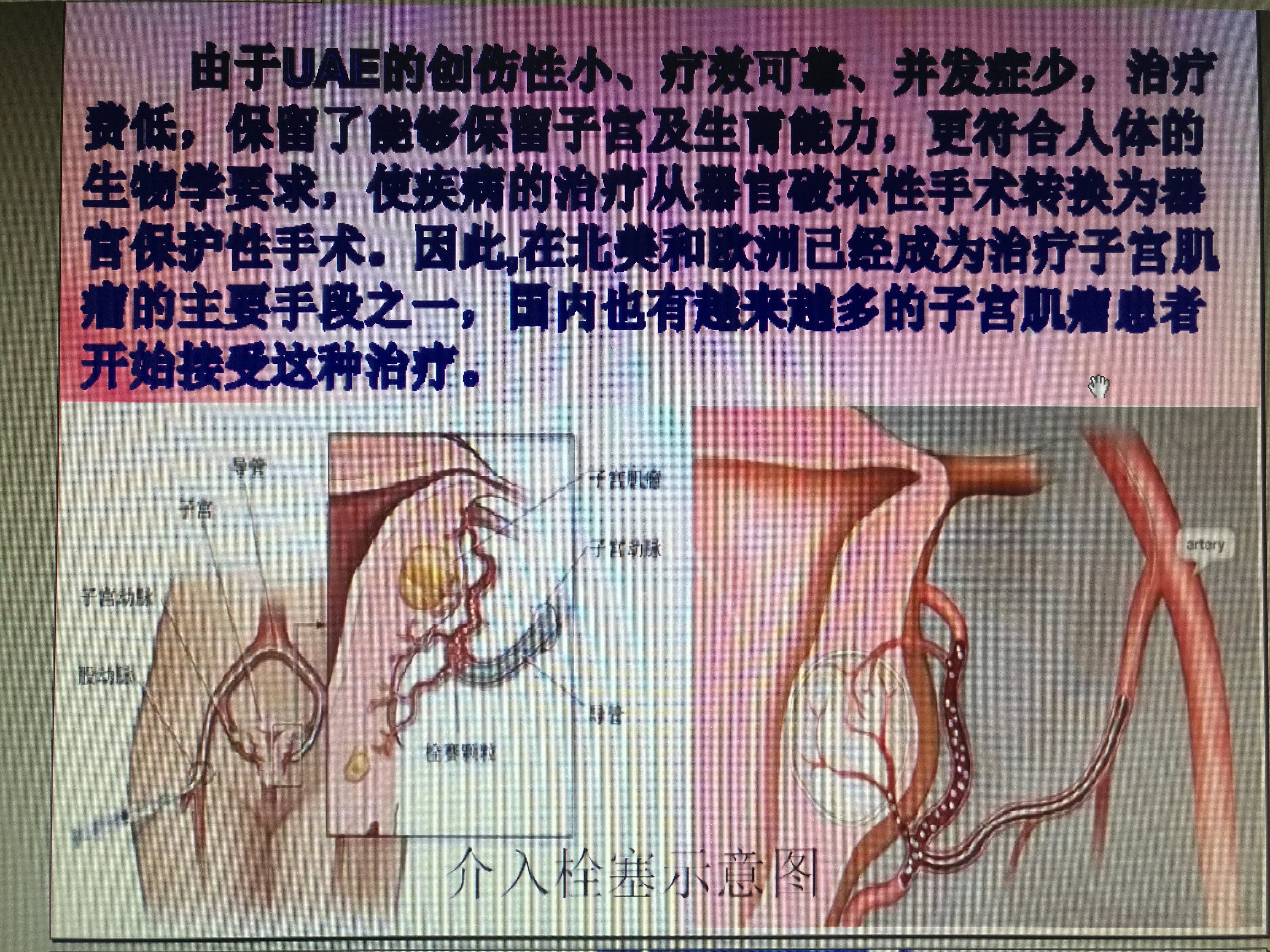 子宫肌瘤介入微创治疗 - 好大夫在线