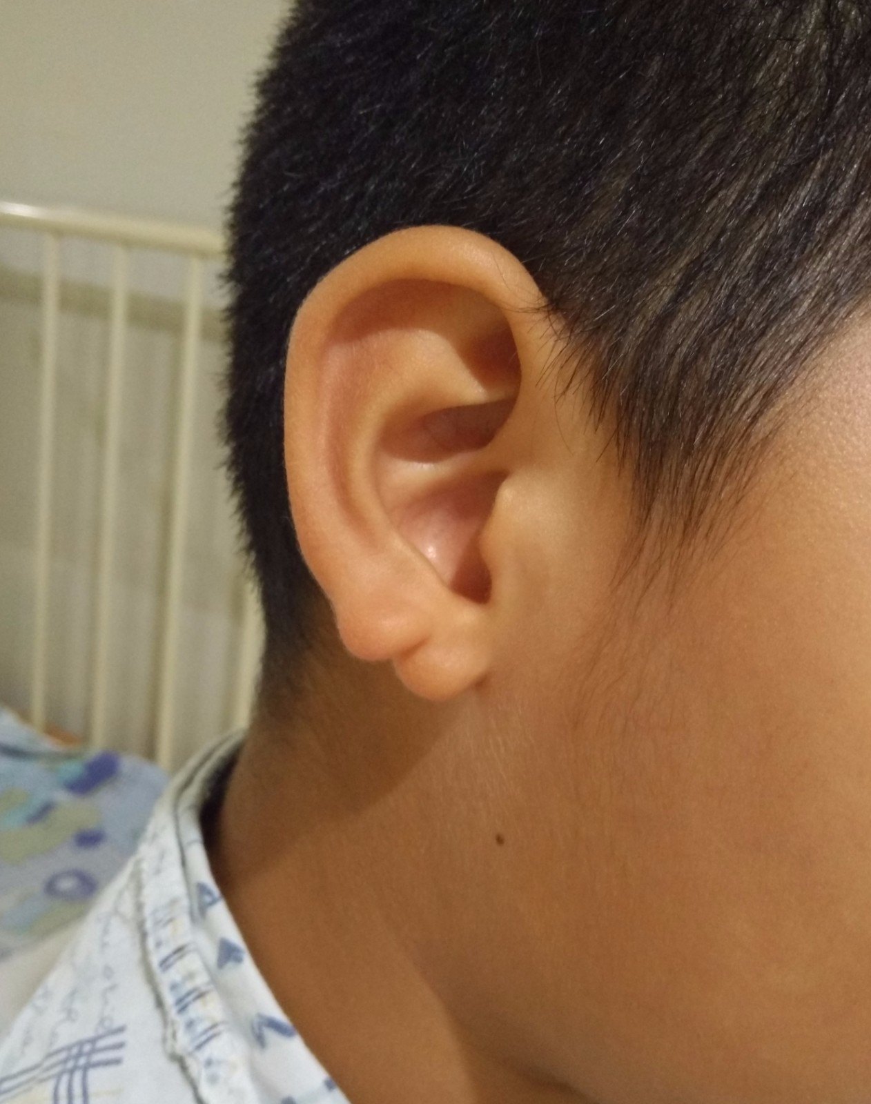 小孩耳朵脆骨断裂图片图片