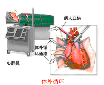 体外循环