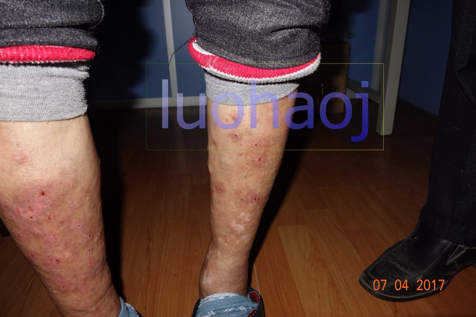 下肢顽固性湿疹伴溃疡案例