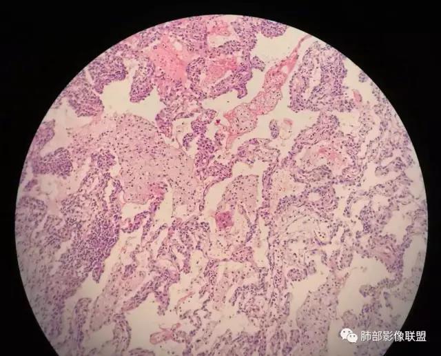 病理3期 第7讲-肺部肉芽肿性炎,普通慢性炎,脓肿病理 - 好大夫在线