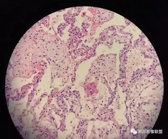 病理3期 第7讲-肺部肉芽肿性炎,普通慢性炎,脓肿病理 - 好大夫在线