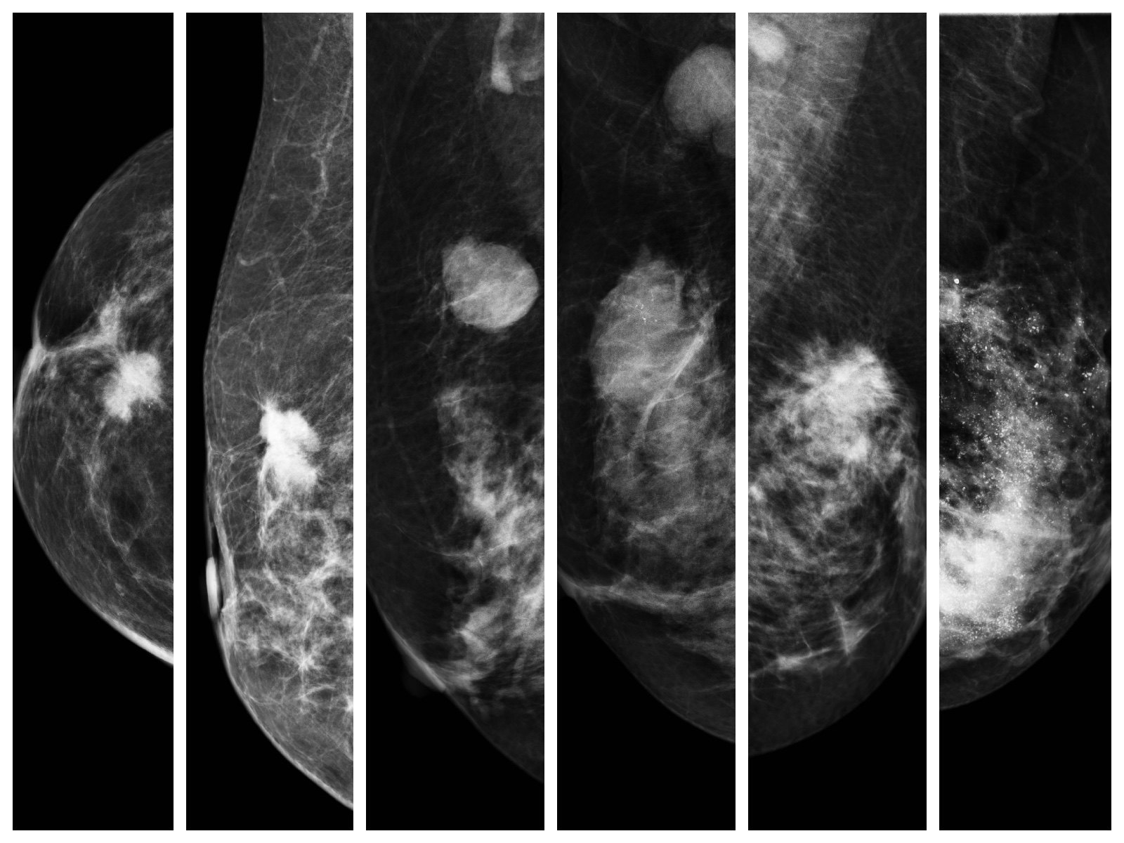 乳腺纤维腺瘤钼靶图片图片