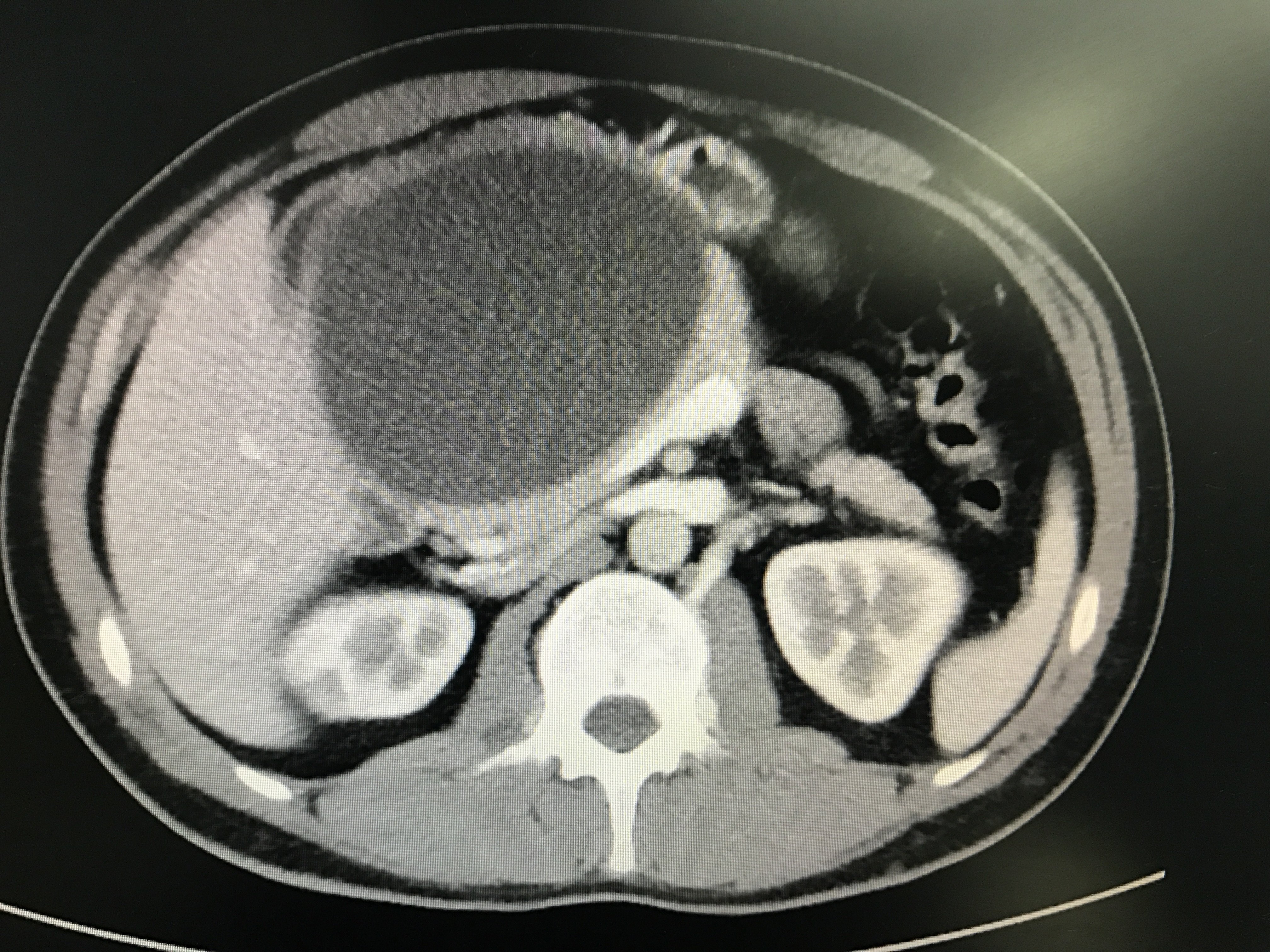 胰腺假性囊肿行囊肿空肠内引流术