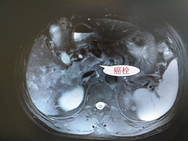肝癌伴门静脉癌栓的手术治疗(附典型手术成功病例)-张友磊教授(上海