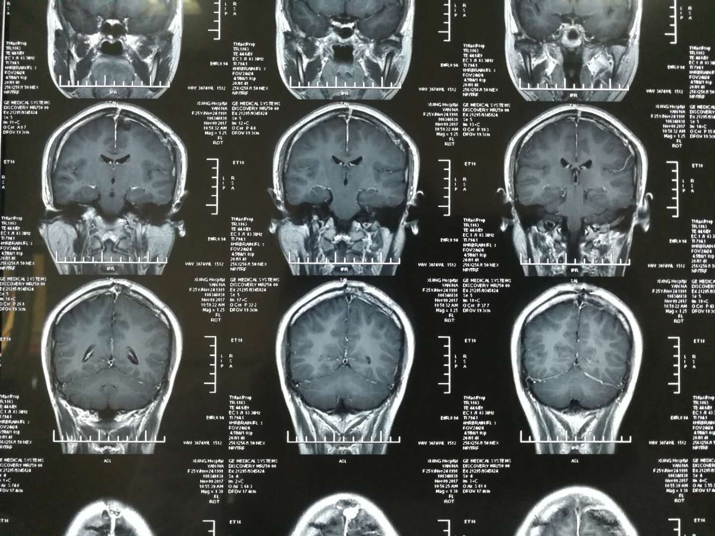 實例展示左頂竇鐮旁腦膜瘤術後半年複查