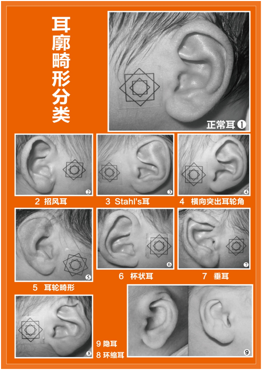 耳朵畸形分类图片图片