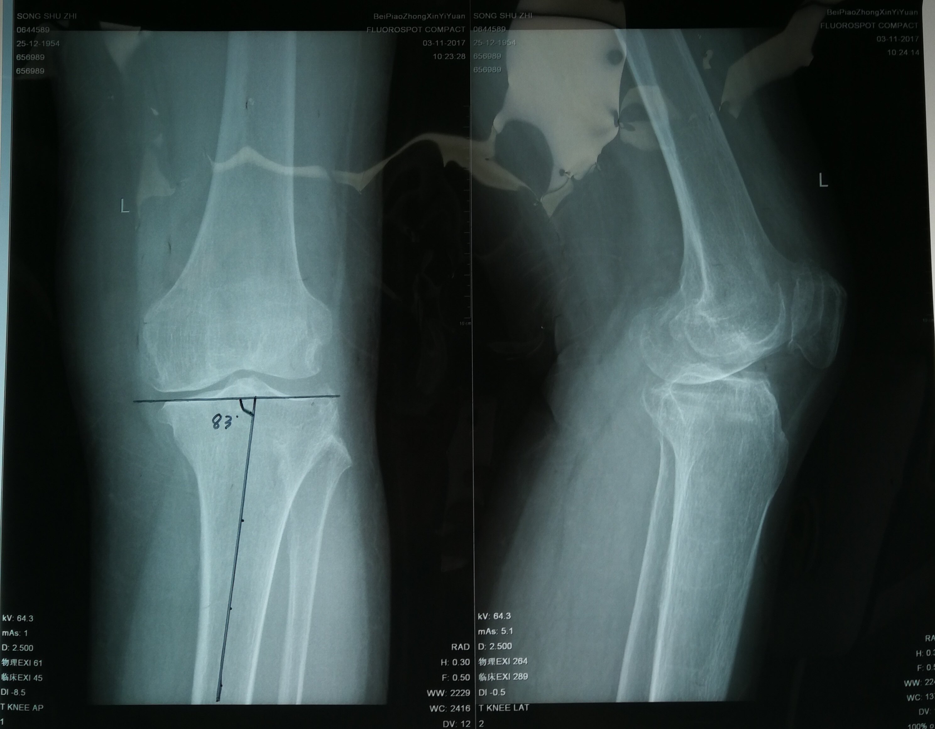 63岁女性,膝关节骨性关节炎,胫骨近端高位截骨术 