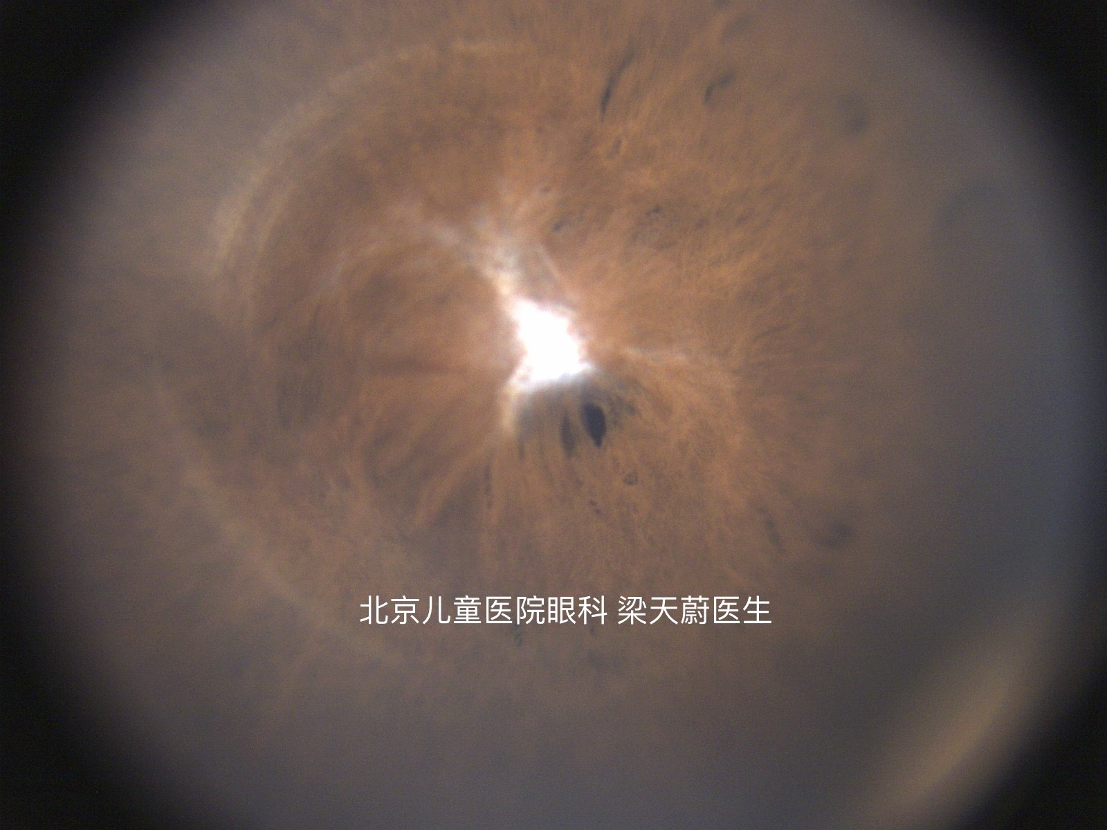 先天性纤维血管瞳孔膜