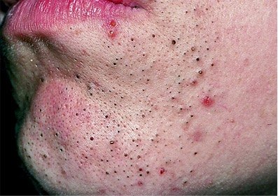 痤疮图片及治疗方法【图片可能会使您感到不适请谨慎点击】 - 好大夫