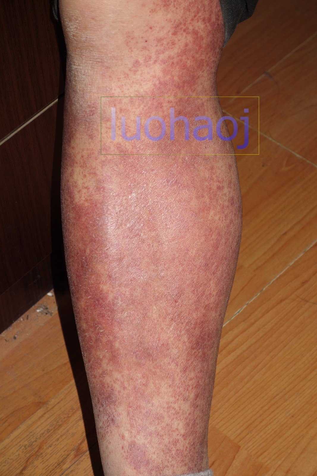 严重的双下肢小腿对称性色素紫癜样皮炎中西结合治疗医案