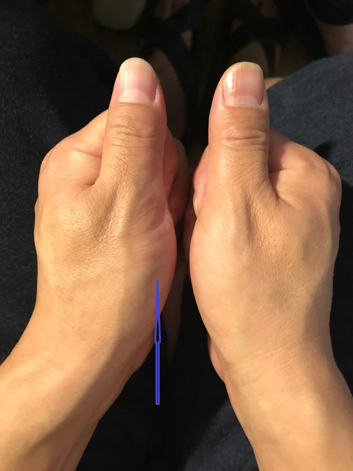 3,部分患者可能表现为大拇指无力,不灵活,大拇指根部(医生称鱼际