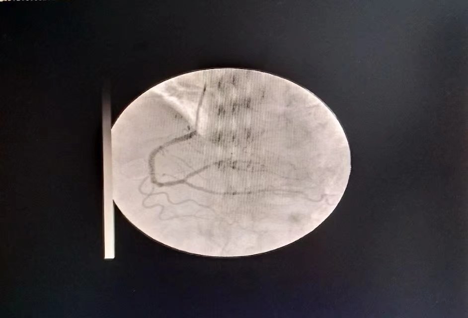 心脏回旋支无法放支架图片