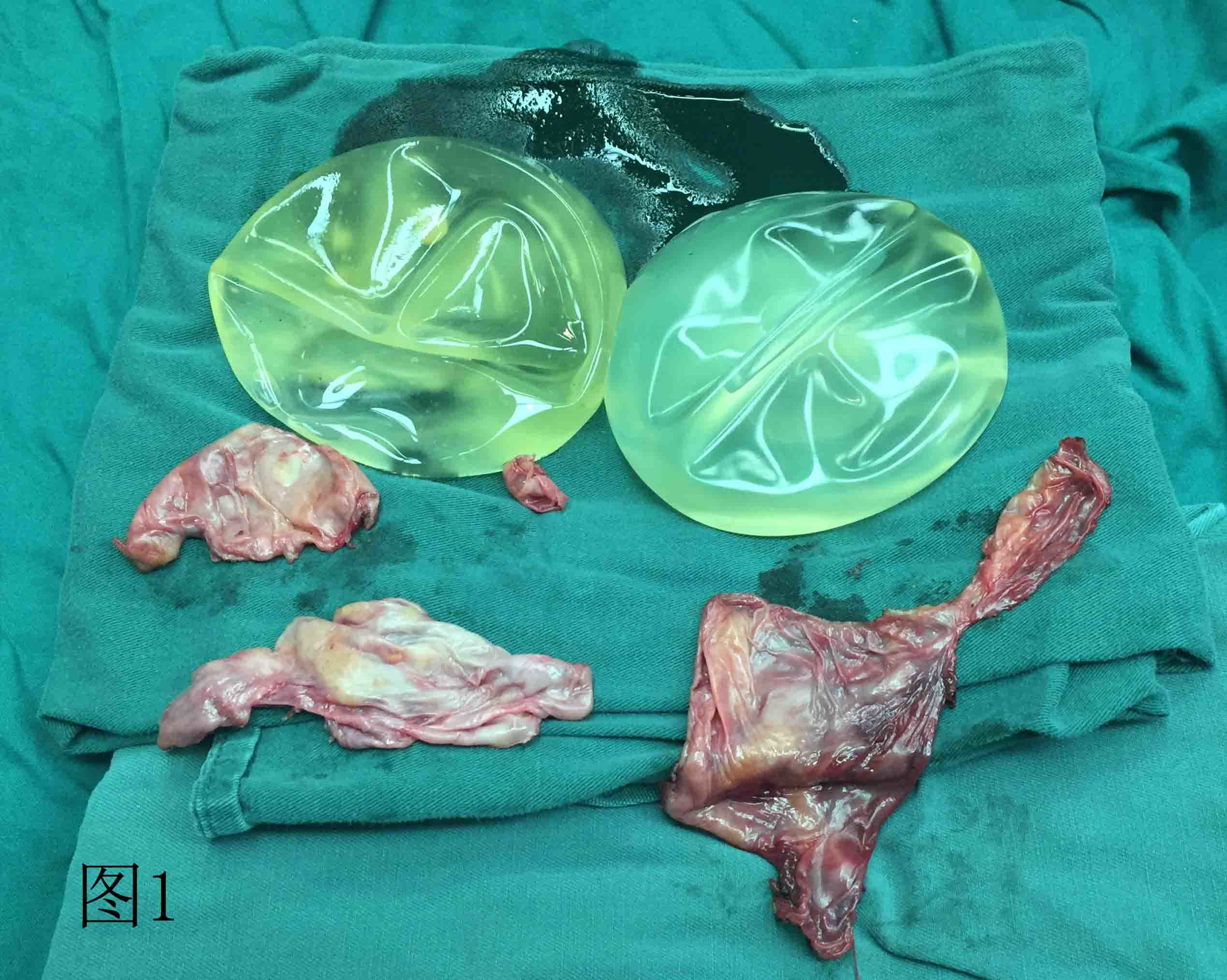假体硅胶_硅胶假体女_硅胶假体隆鼻可以一辈子不取吗