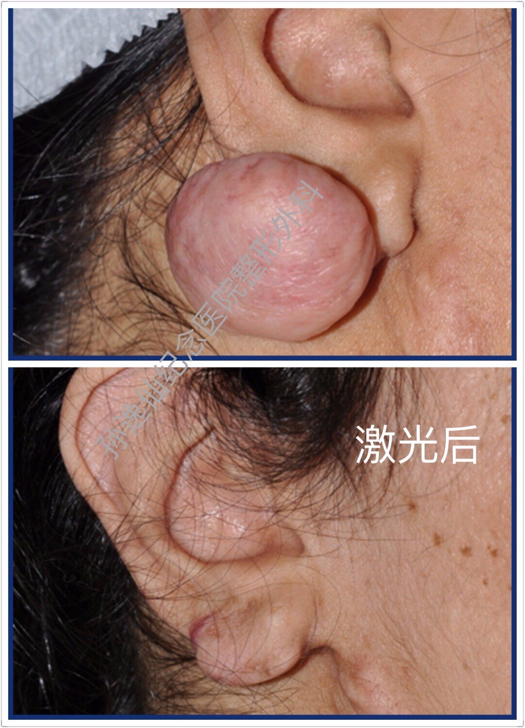 点阵激光治疗疤痕