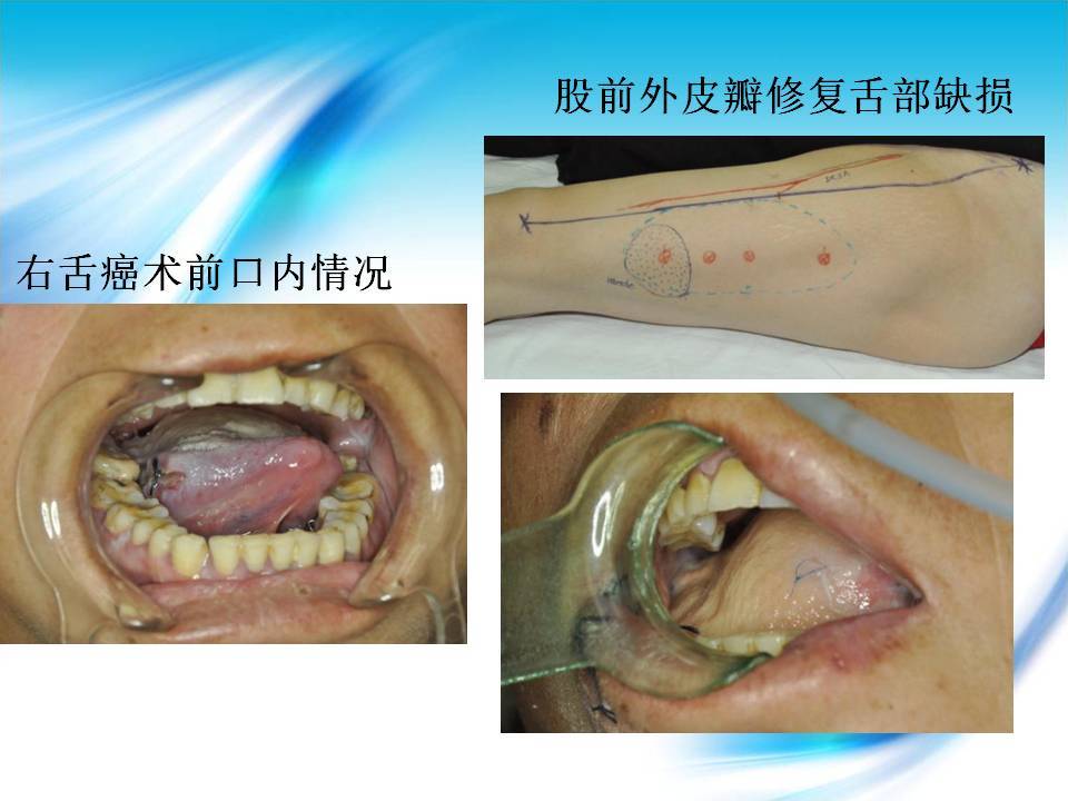 口腔颌面部肿瘤的显微外科皮瓣重建