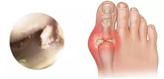 烦人的膝关节痛风!