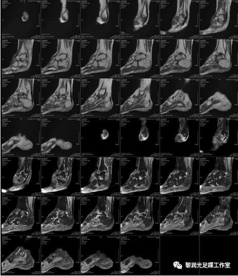 中风引起的脚部畸形如何治疗?