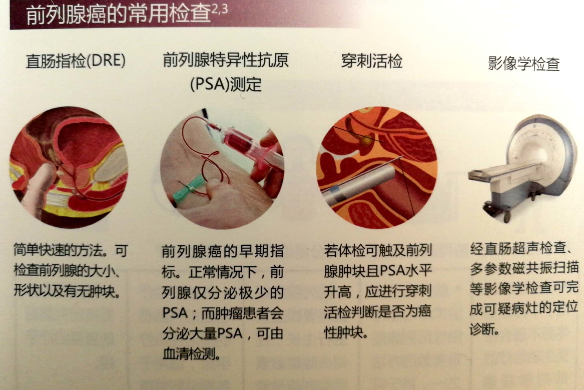 CRPC前列腺癌图片