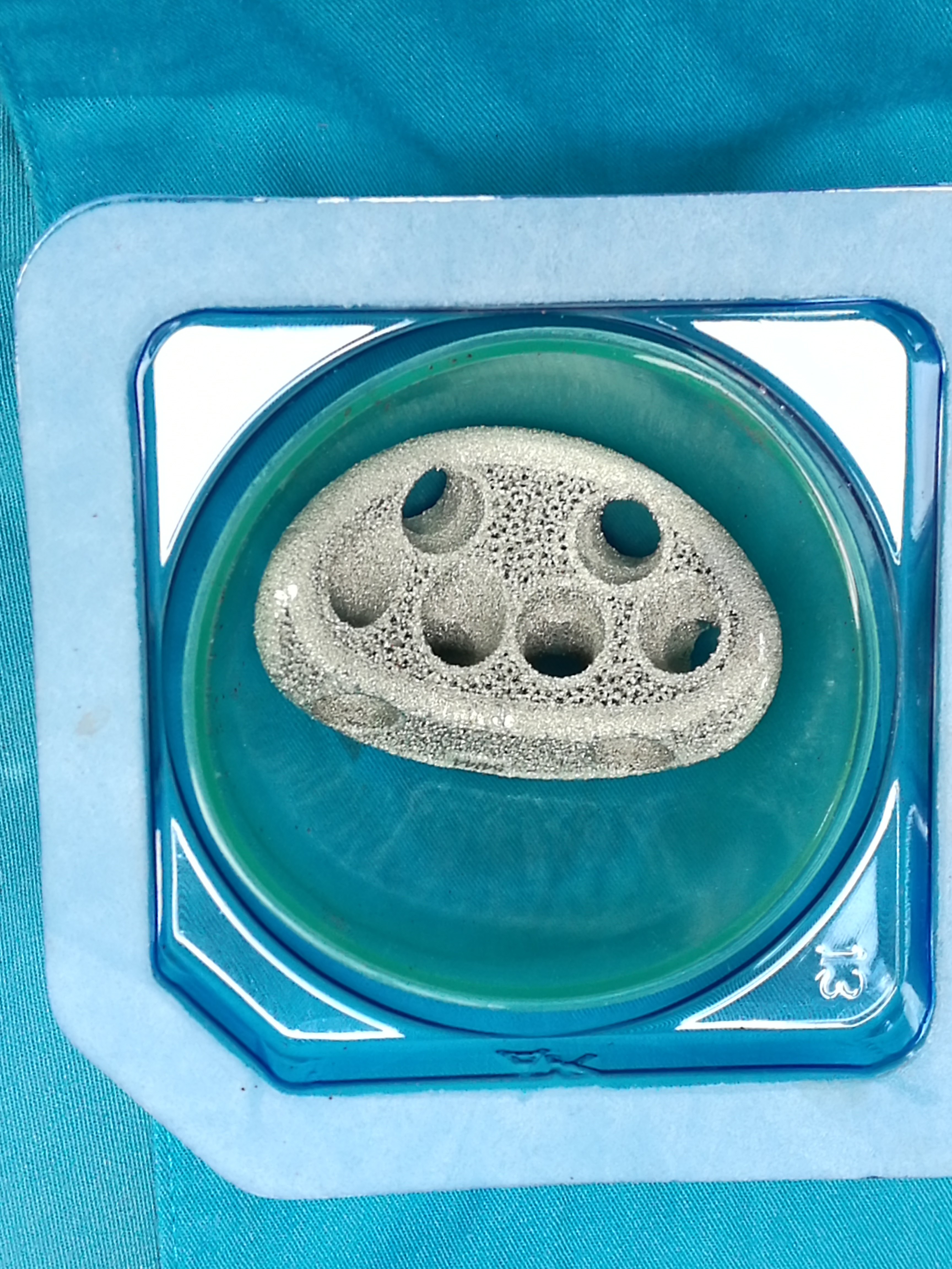 翻修20年前的人工髋关节 - 好大夫在线