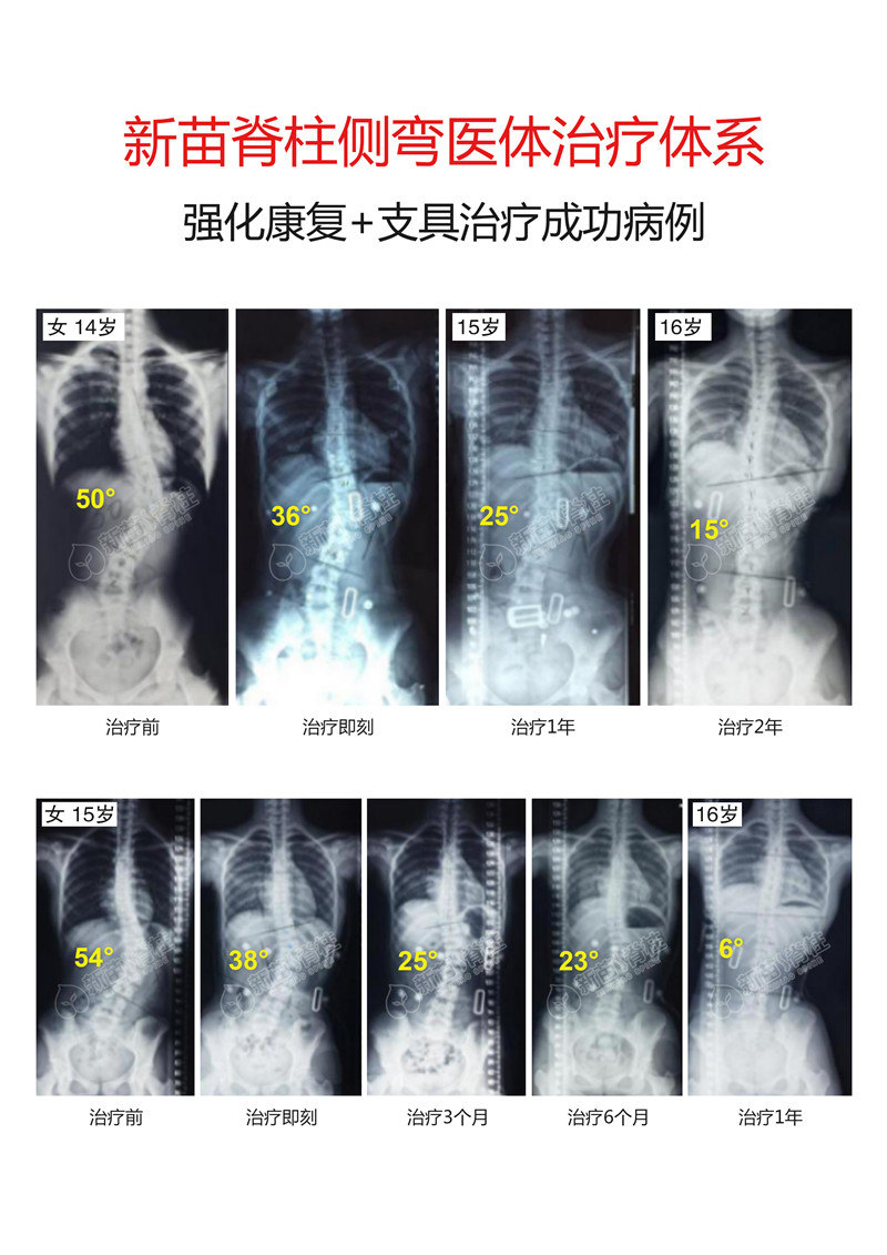 新苗脊柱侧弯医体治疗体系4060度治疗好转的病例