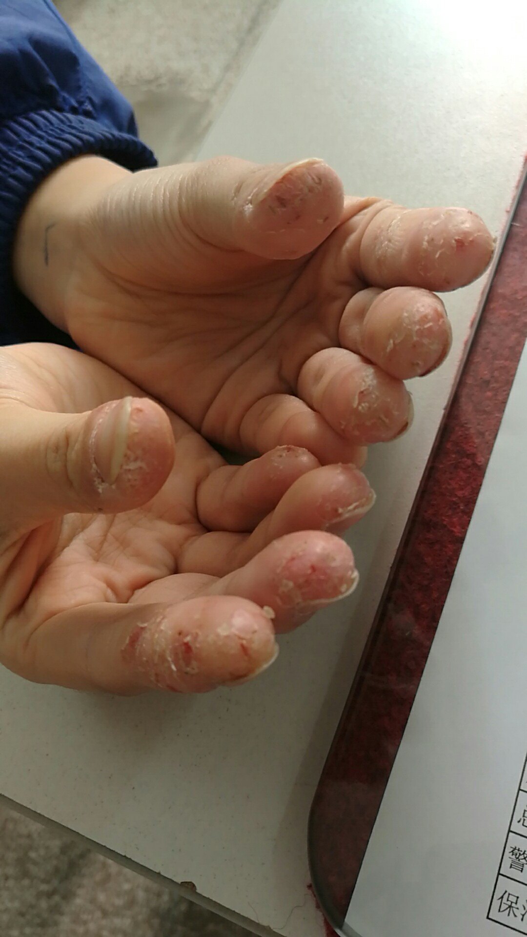 冬季手部皮肤反复发作干燥,瘙痒,皲裂怎么办? - 好大夫在线