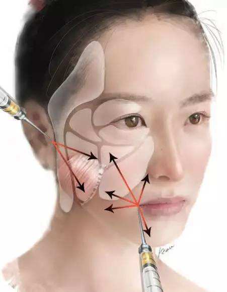 面部自体脂肪填充适用人群及效果如何?