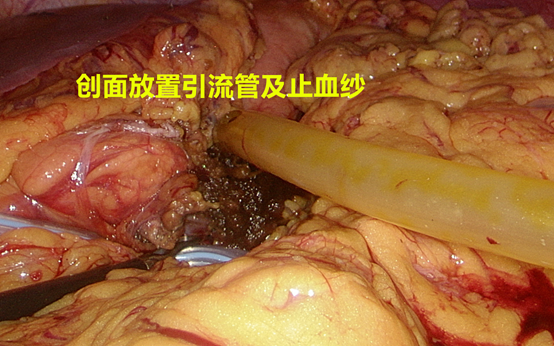11.仔细观察脾脏有无缺血.10.胰体尾切除后创面.9.