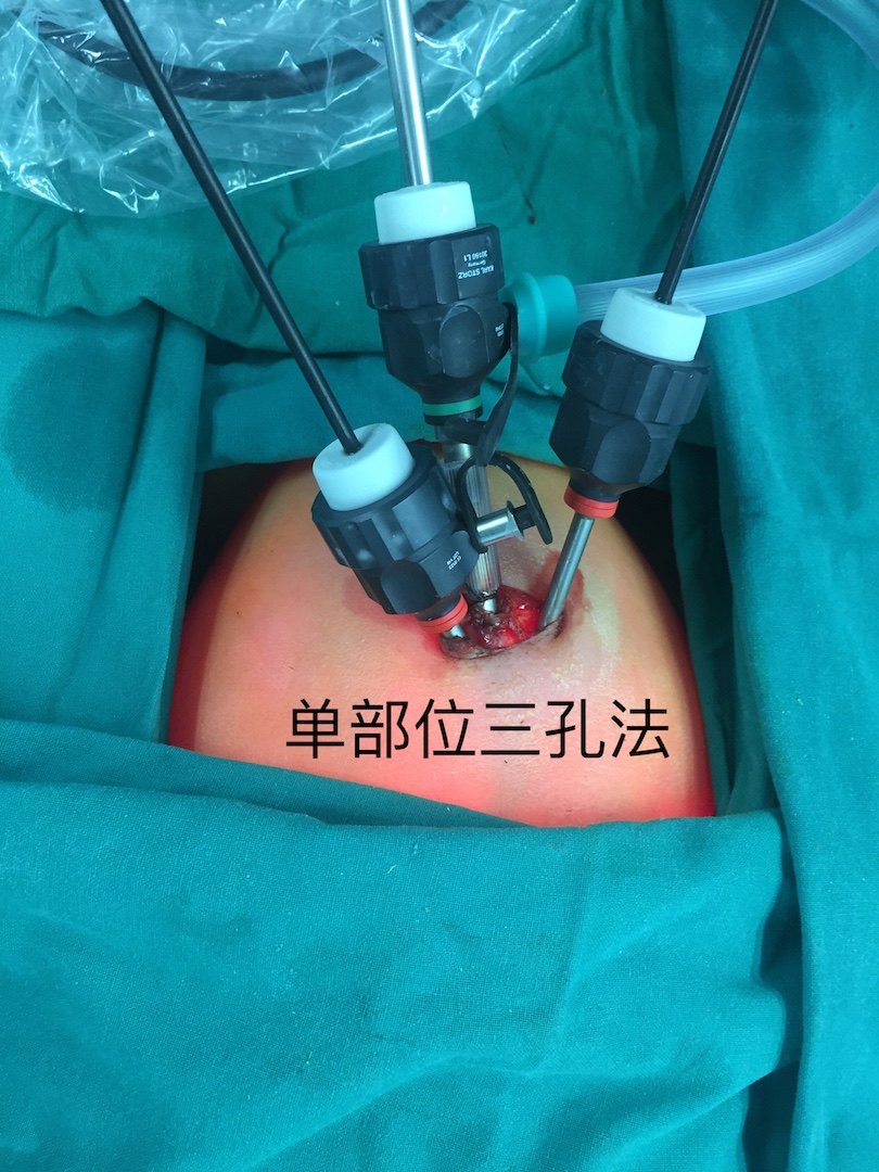 股疝的手术切口示意图图片