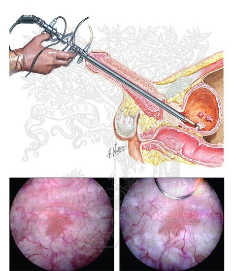经尿道膀胱肿瘤电切术图片