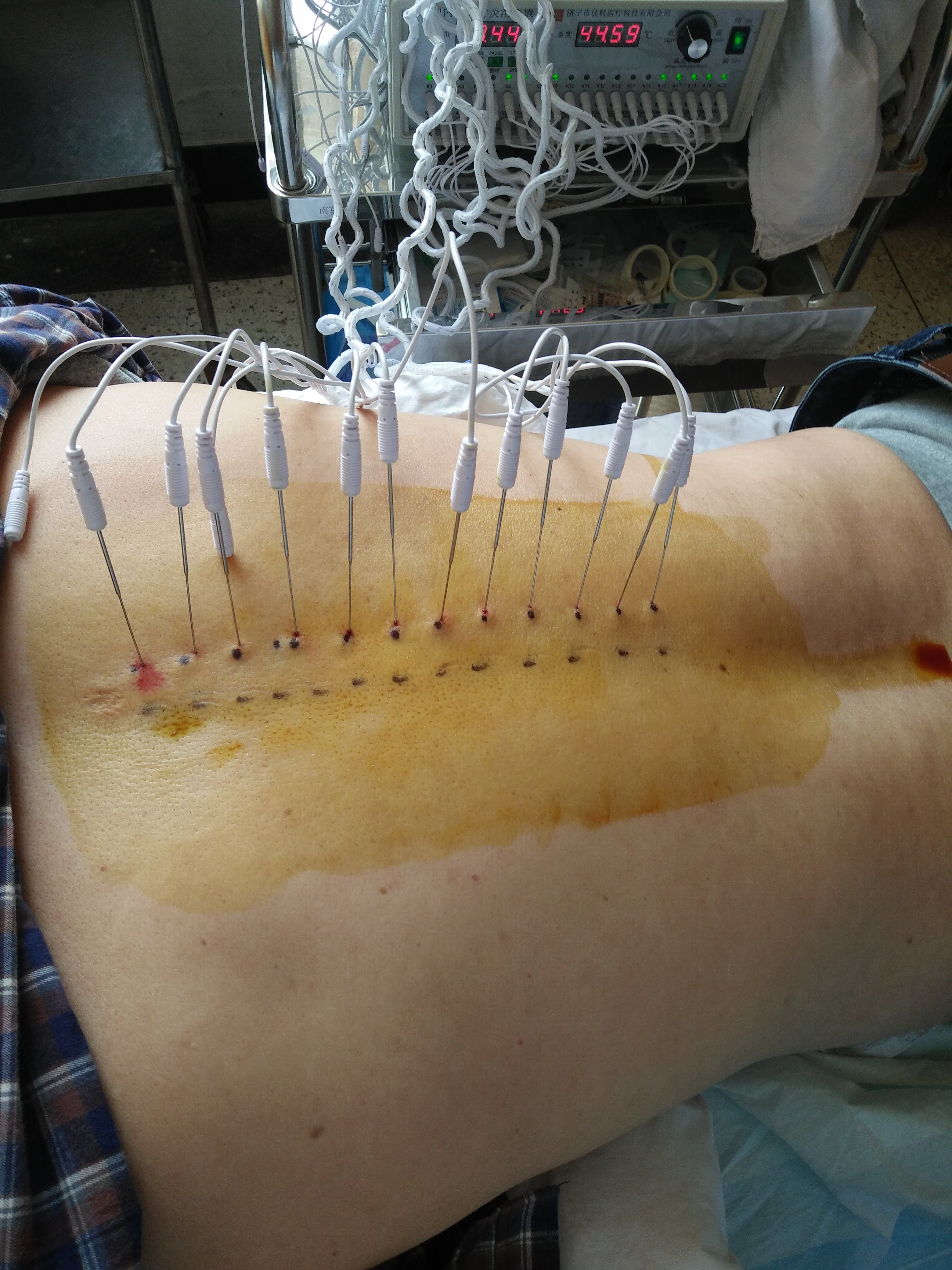 带状疱疹治疗病例