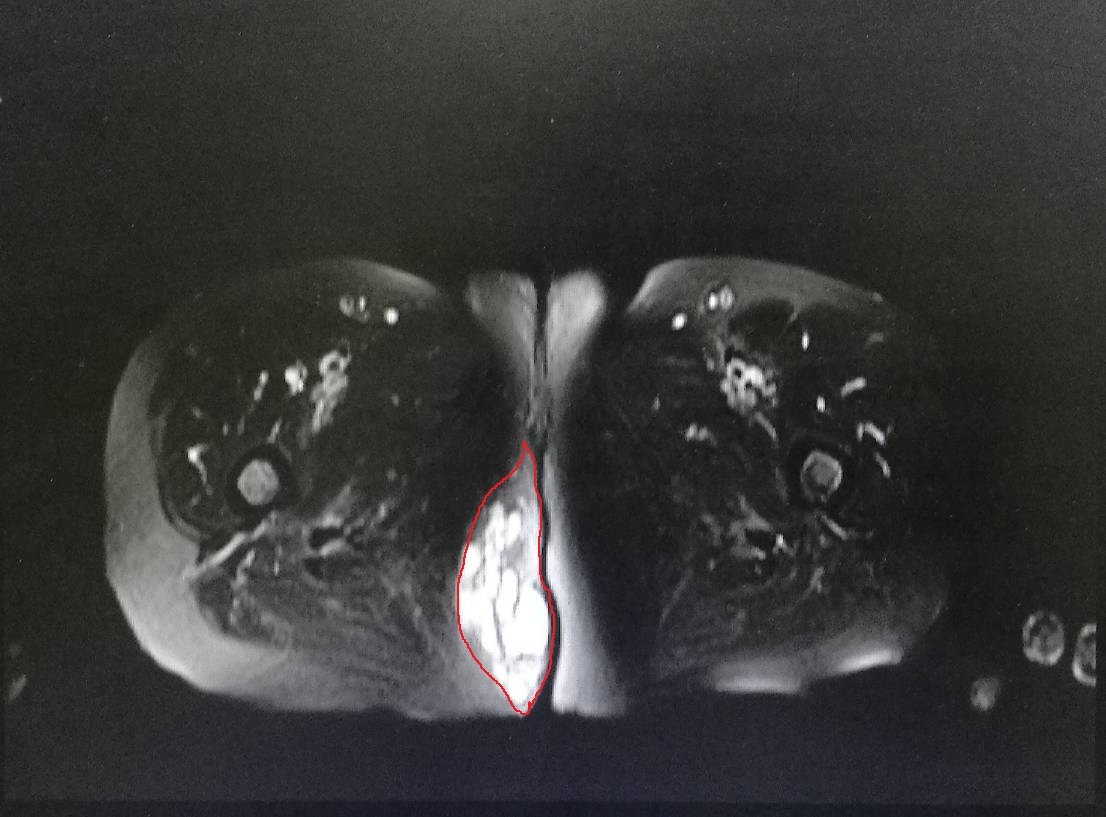 表皮囊肿黑色图片