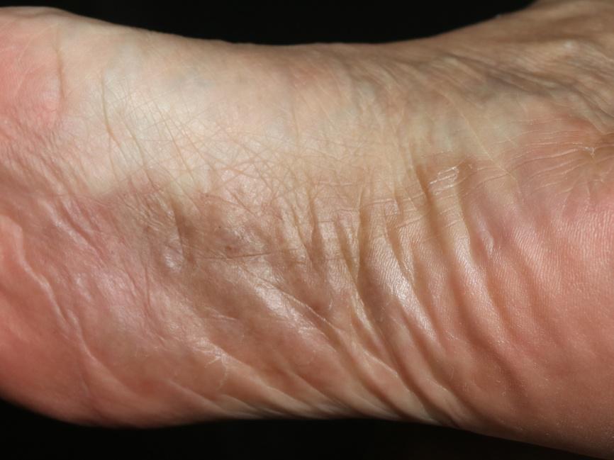 持久性隆起性红斑 - 好大夫在线