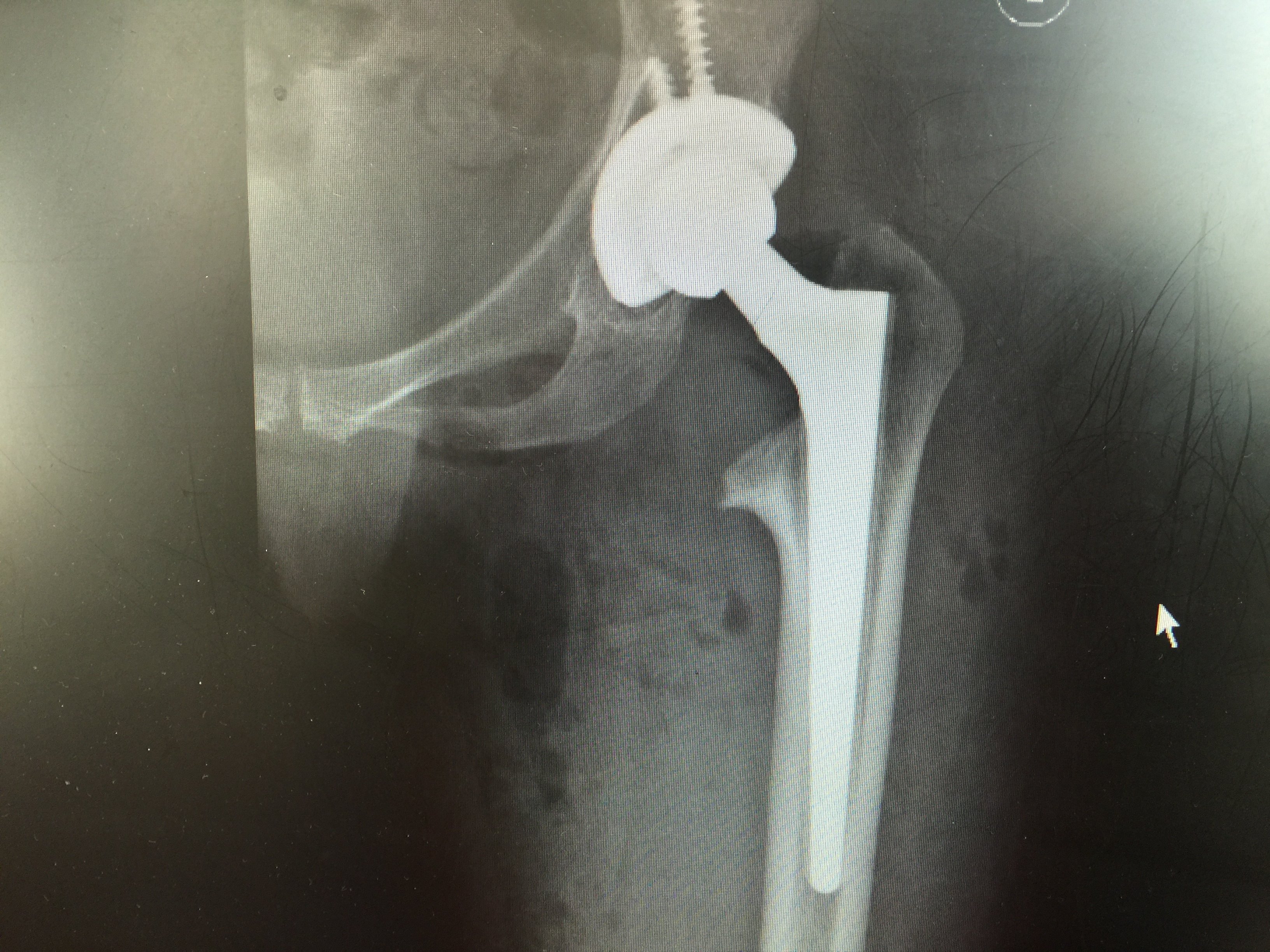 先天性扁平髋髋关节置换