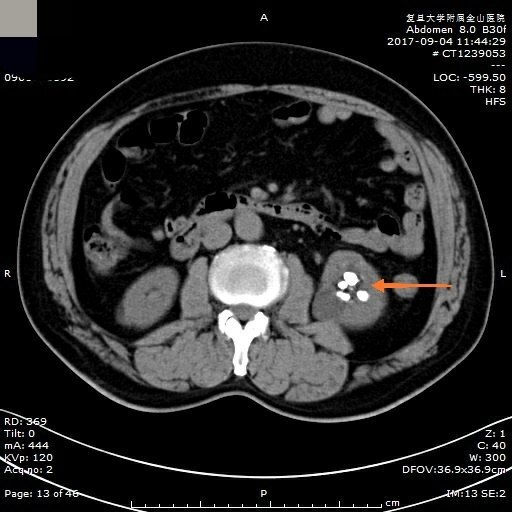 男性泌尿系统解剖图ct图片