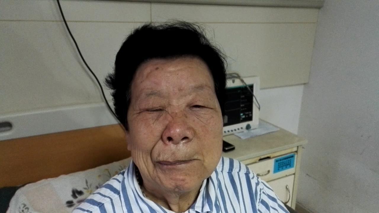 面肌痉挛的典型症状及鉴别诊断 - 好大夫在线