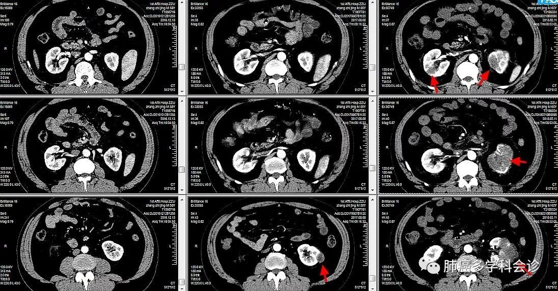 肺癌肾脏转移,也别太大意! - 好大夫在线