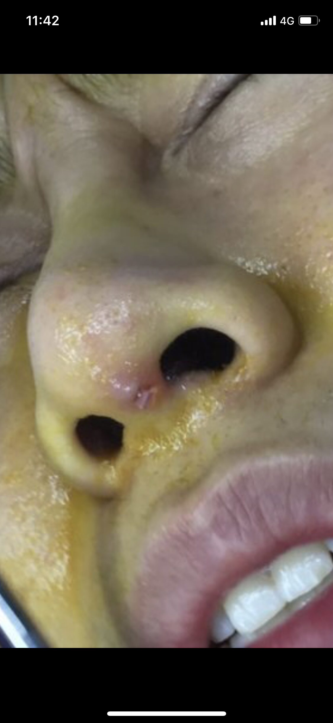 假体剪断鼻小柱假体外露部分切除完毕第四:  鼻头感染性发红的表现