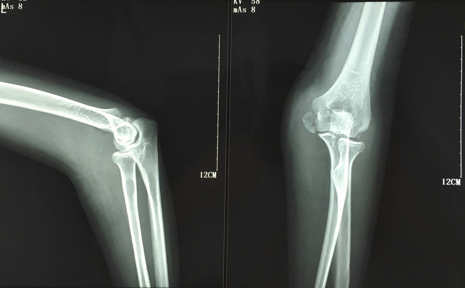 怀孕期间骨折了 该如何是好 好大夫在线 怀孕期间骨折了 该如何是好 好大夫在线