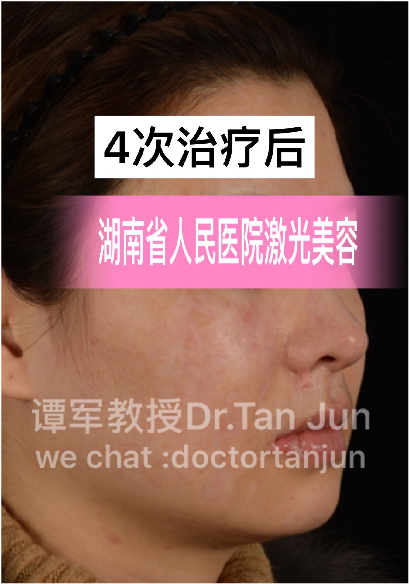 光子嫩肤医院多少钱一次_医院脸部光子嫩肤多少钱_光子嫩肤医院价格