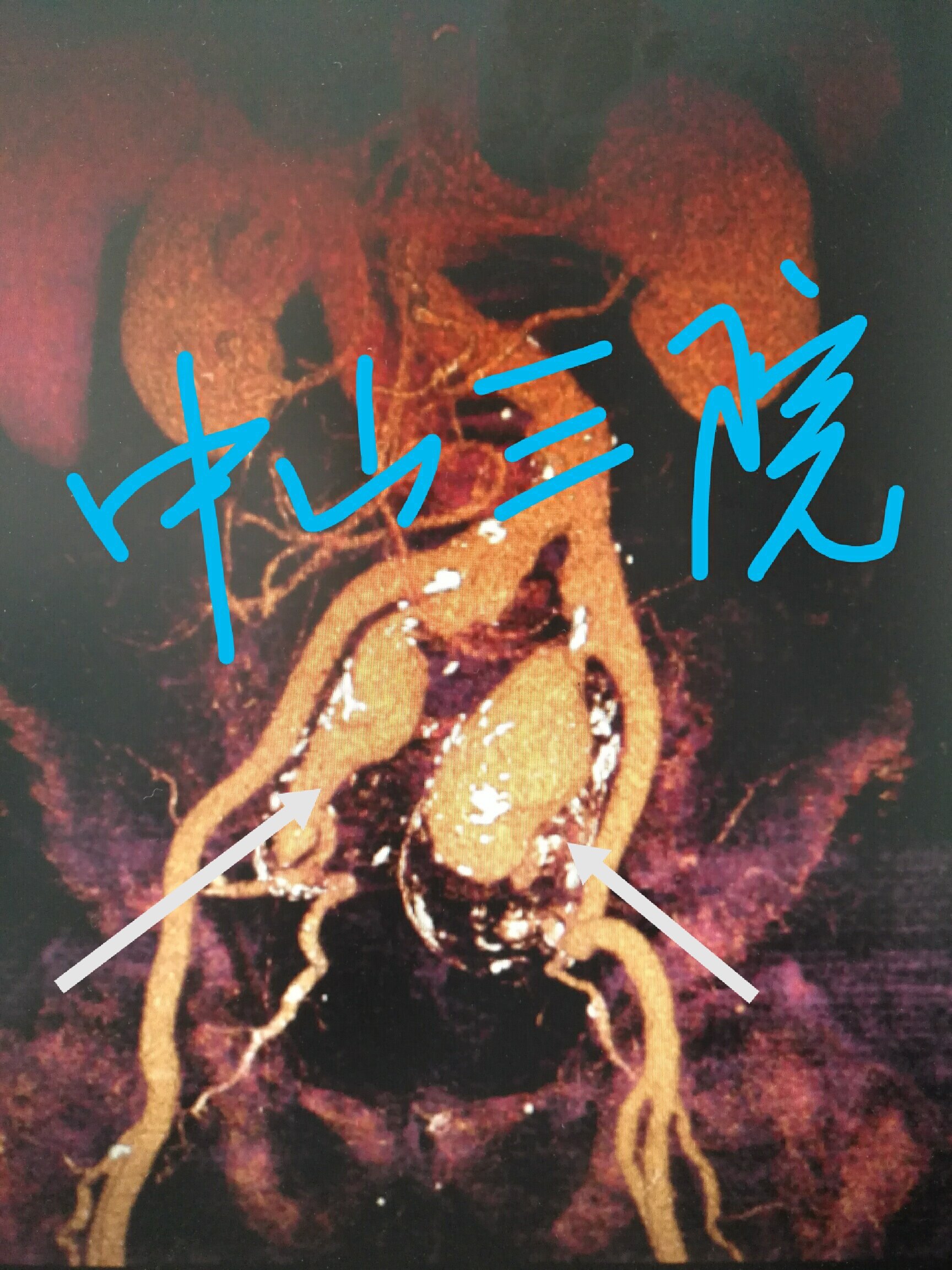 腔内支架植入治愈双侧巨大髂内动脉瘤