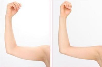手臂吸脂减肥会不会留疤痕?