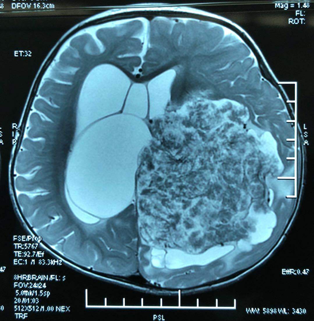 脉络丛乳头状瘤影像图片