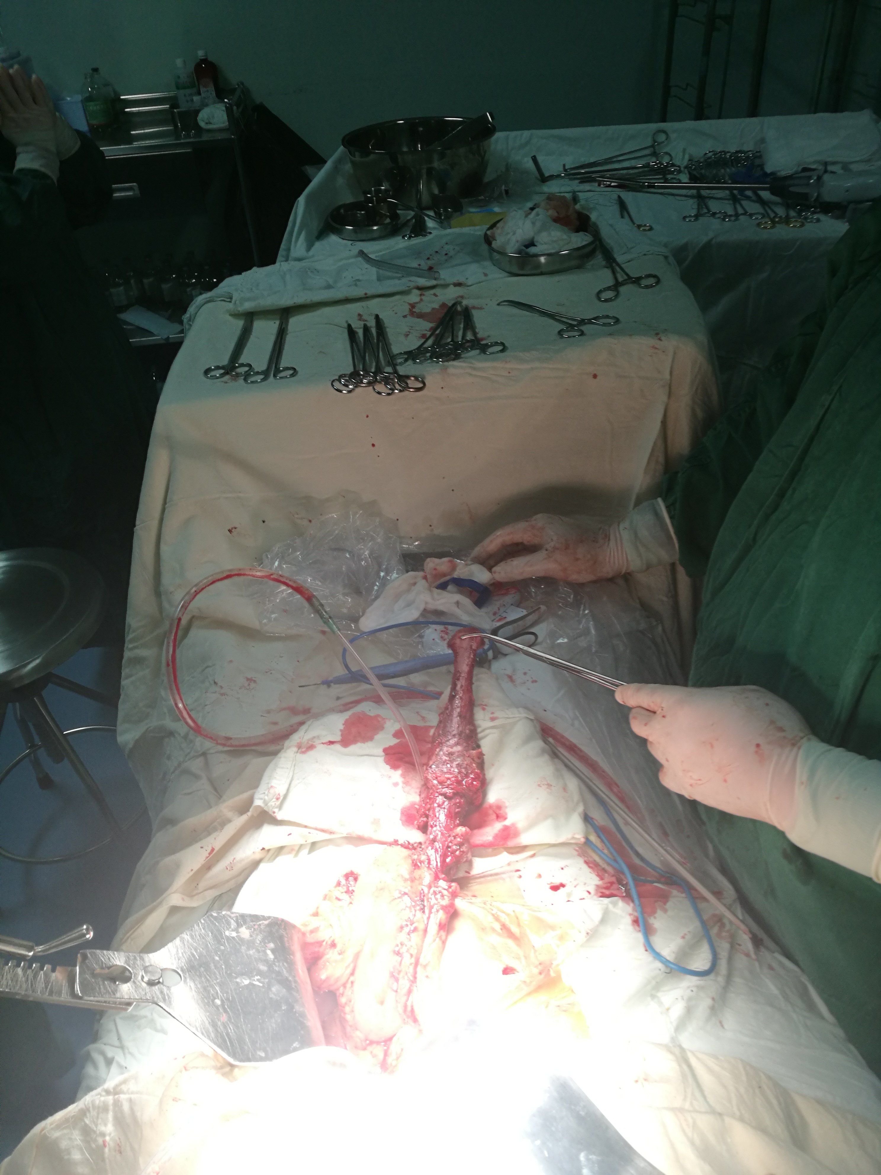 微创食管癌切除术(mie) - 好大夫在线