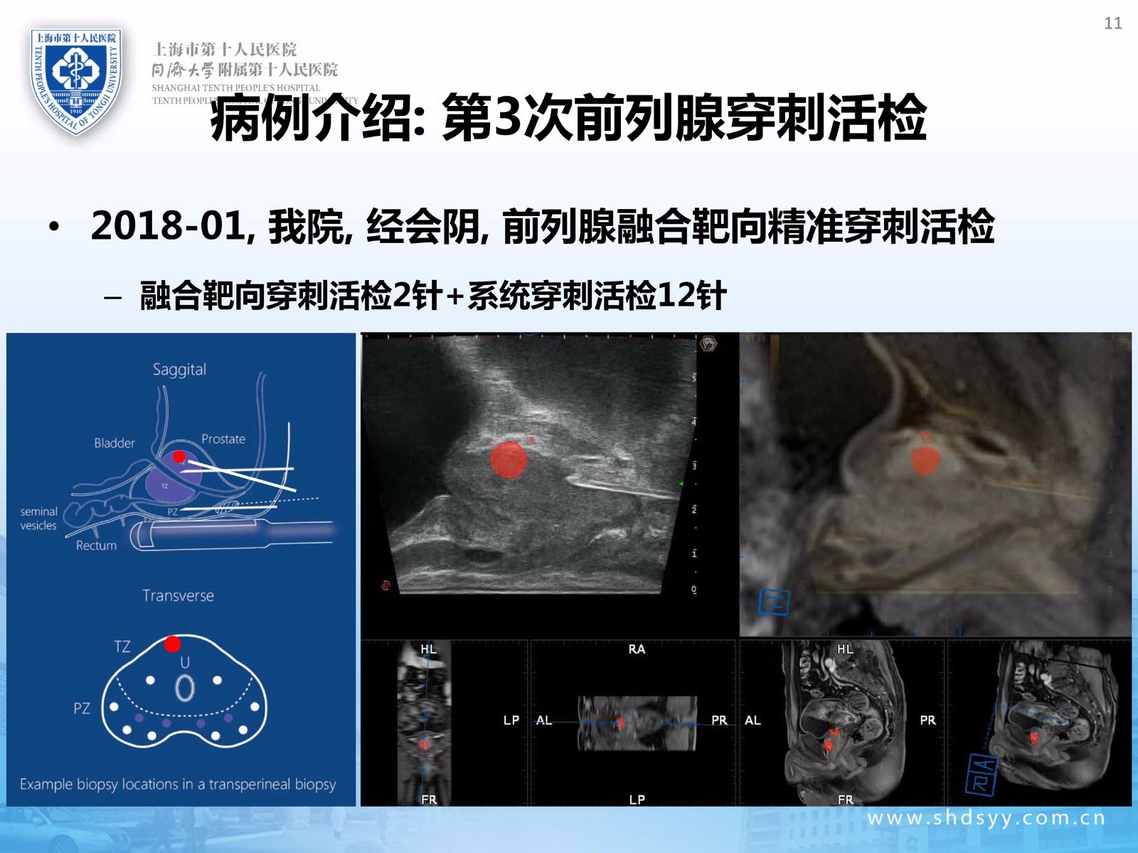 前列腺癌多學團隊為老嚴進行了多參數核磁共振與經直腸超聲實時融合